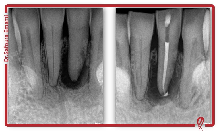 مدیریت دندان با کانال های کلسیفیه شده (Calcified canals)